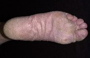 Oznaki i objawy grzyba na nogach