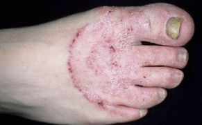 Przyczyny pojawienia się grzyba na nogach