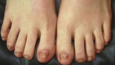 Etapy rozwoju grzybów paznokci