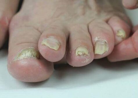 leczenie grzybicy paznokci lekami