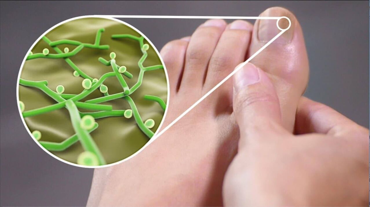 patogeny grzyba paznokci